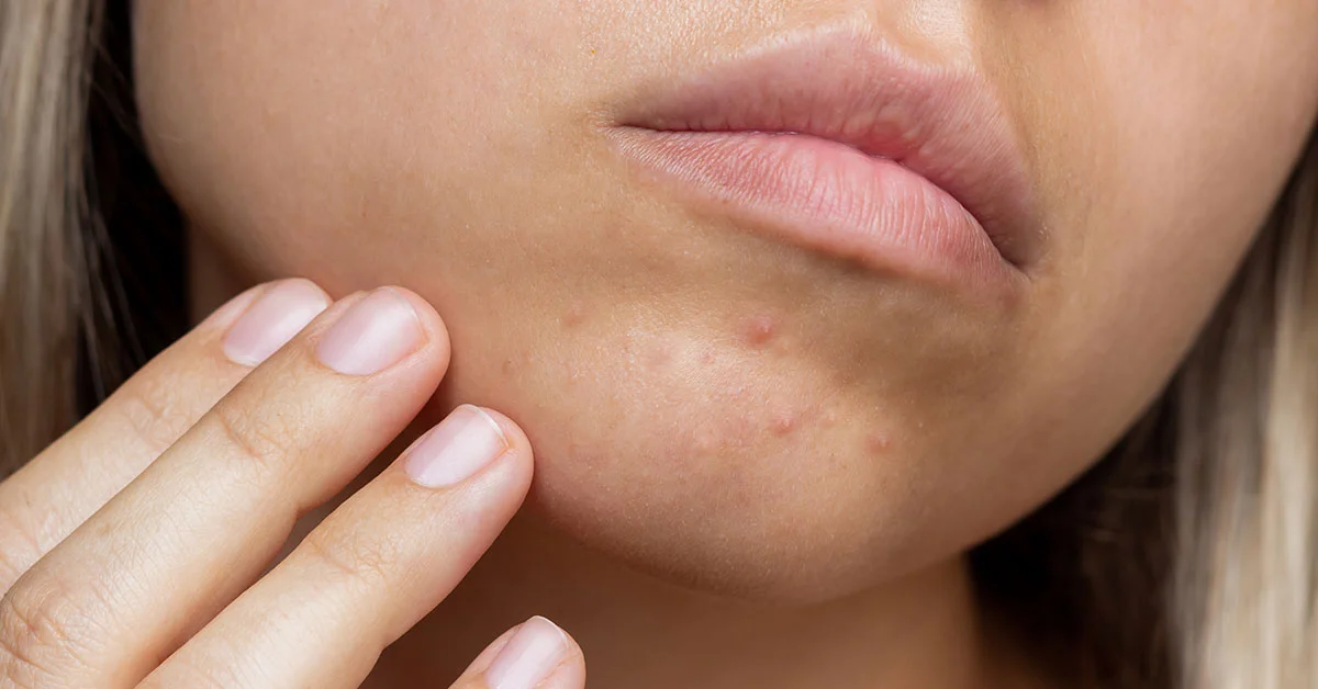 acne-peau-acneique